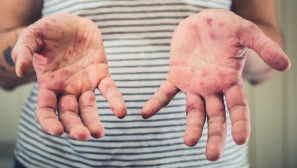 Saúde do Acre Investiga Quatro Casos Suspeitos de Sarampo: Medidas de Prevenção Intensificadas Imagem do artigo