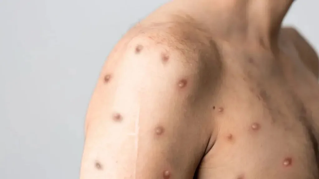 Rio Branco Confirma Primeiro Caso Suspeito de Mpox: Vigilância em Saúde Acompanha Situação