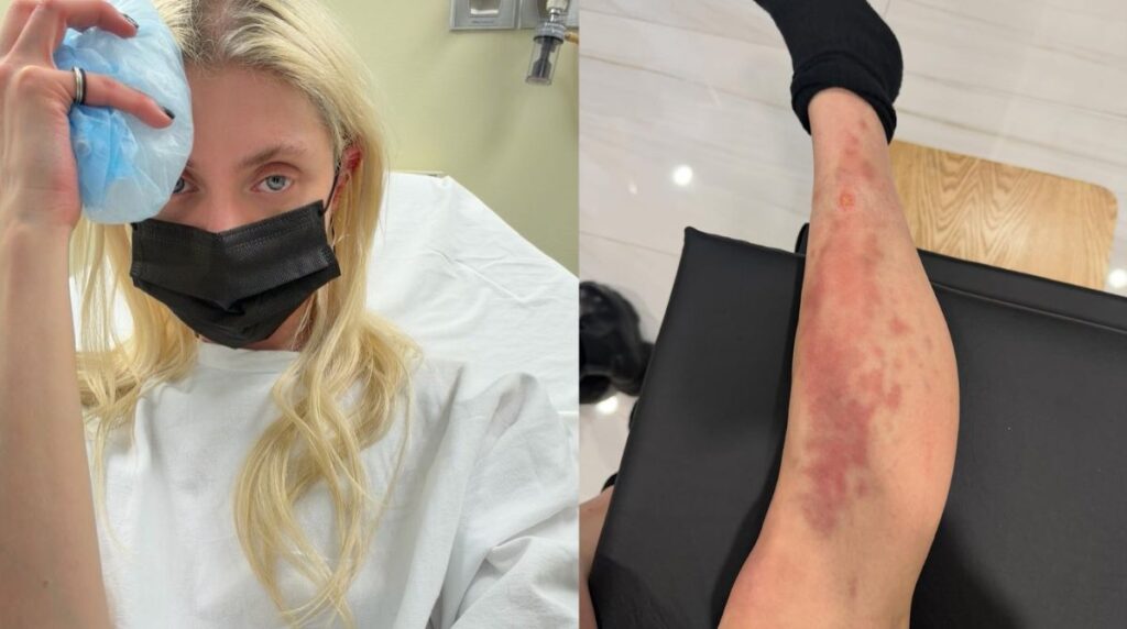 Taylor Momsen é Picada por Aranha e Hospitalizada, Mas Afirma: 'O Show Tem que Continuar'